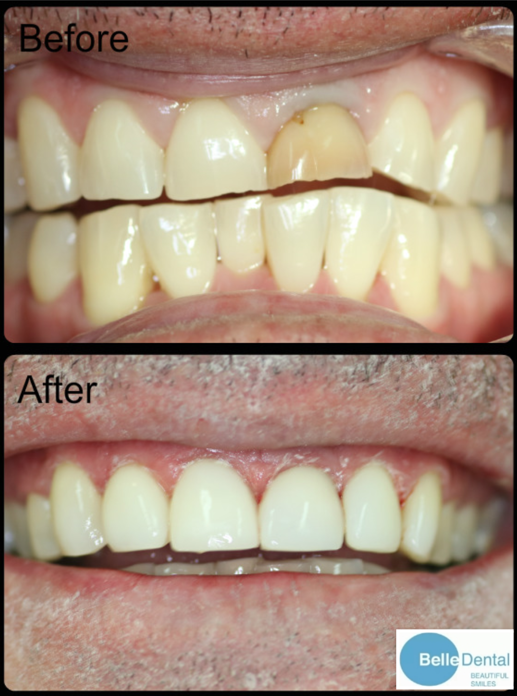 Composite Resin Veneers BelleDental June 22, 2018