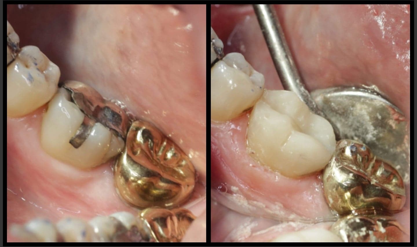 Composite Resin BelleDental