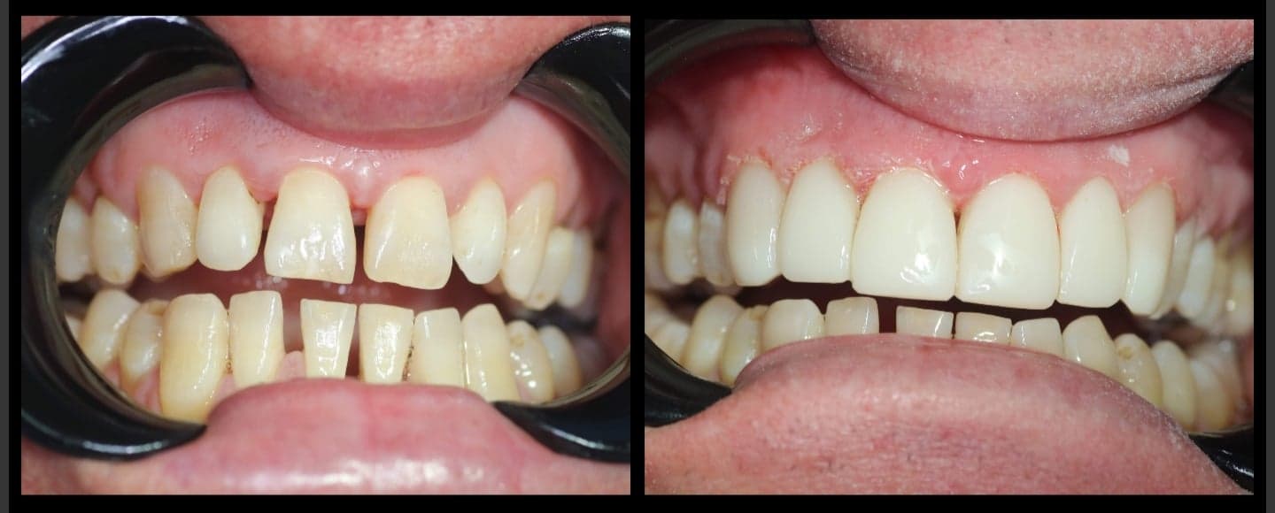 Composite Resin BelleDental