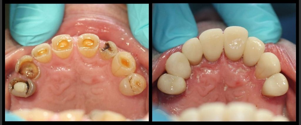 Composite resin belledental