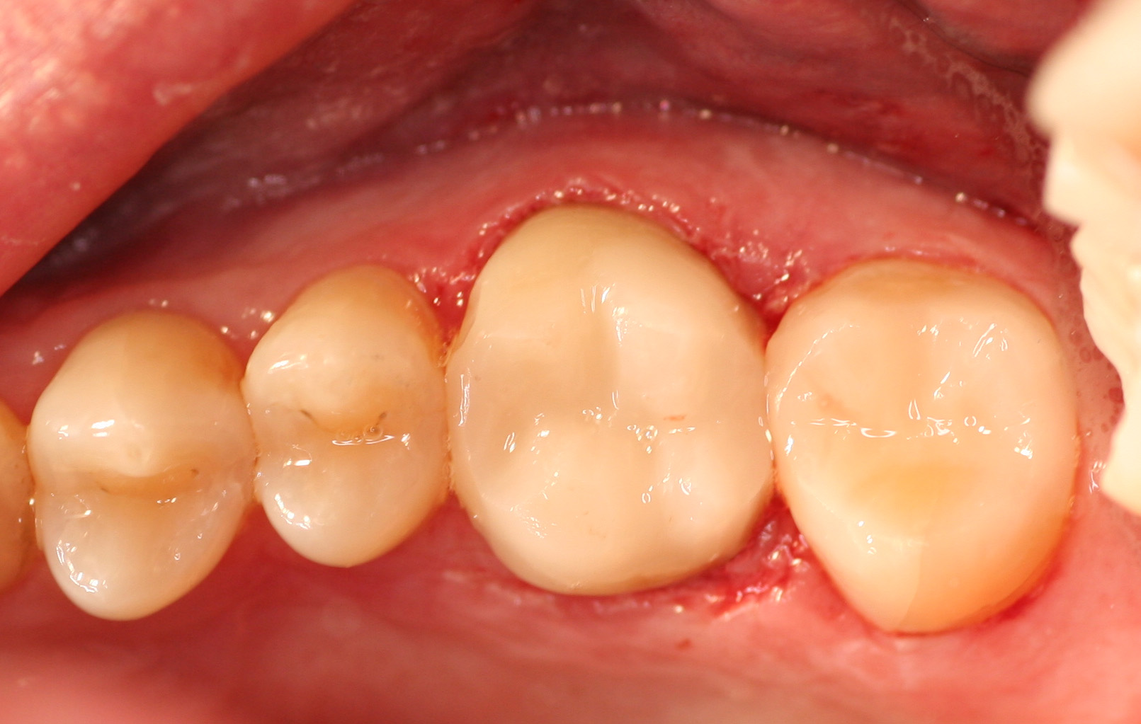 CRC's Composite Resin Crowns BelleDental